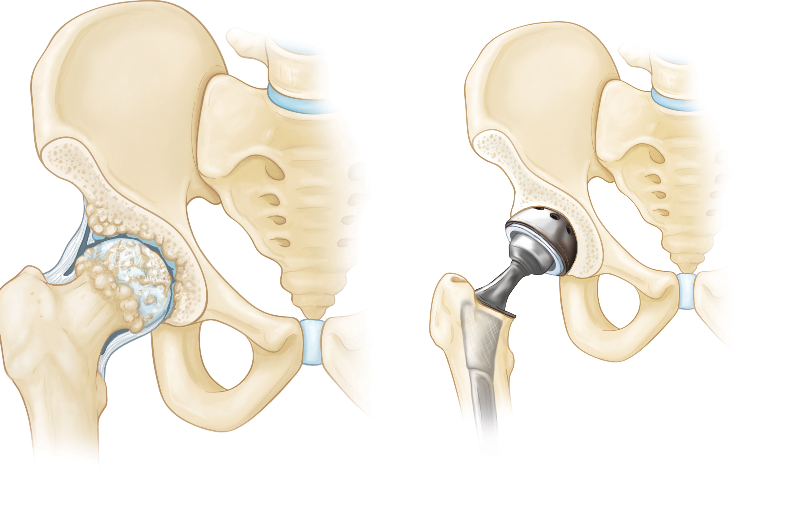 ip with osteoarthritis and hip with hip implant