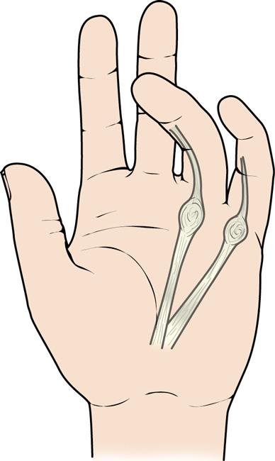 Dupuytren's contracture