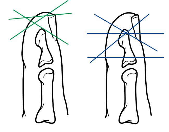 Angle of fingertip wounds