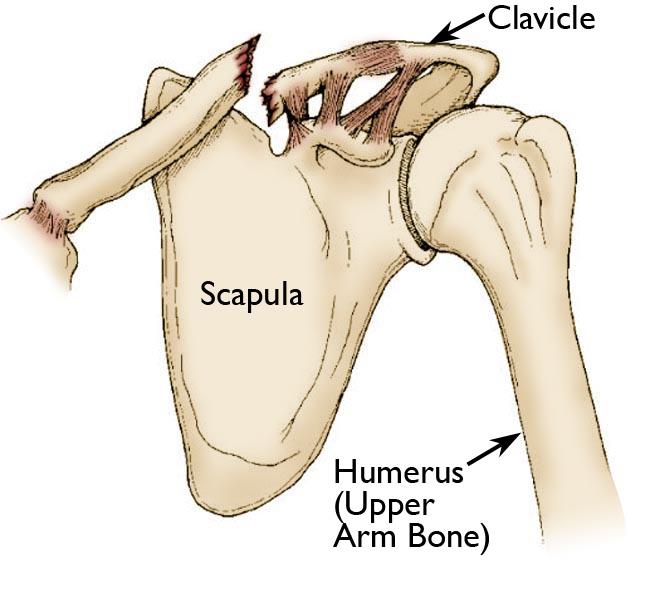 Clavicle fracture