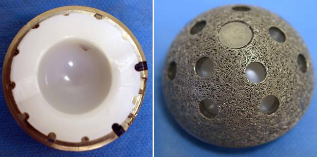 acetabular component of hip replacement