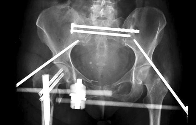 External fixation of pelvic fracture