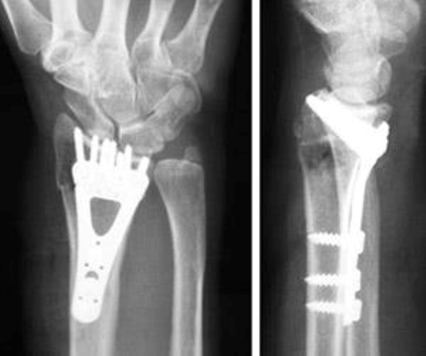 internal fixation for distal radius fracture