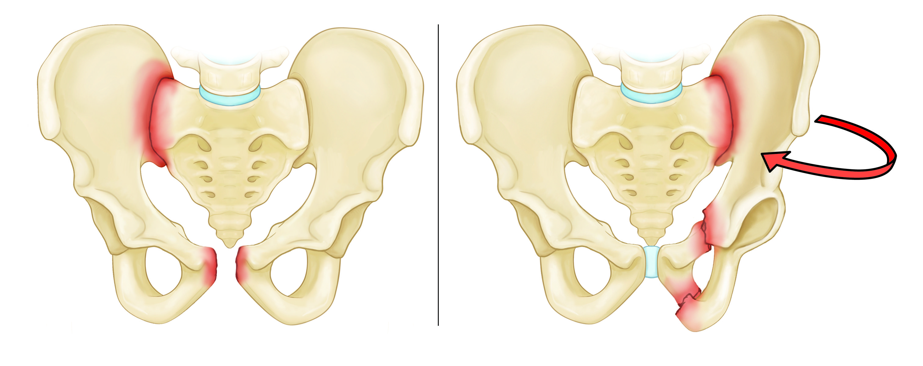 Anterior-posterior compression and lateral compression fractures pelvic fractures
