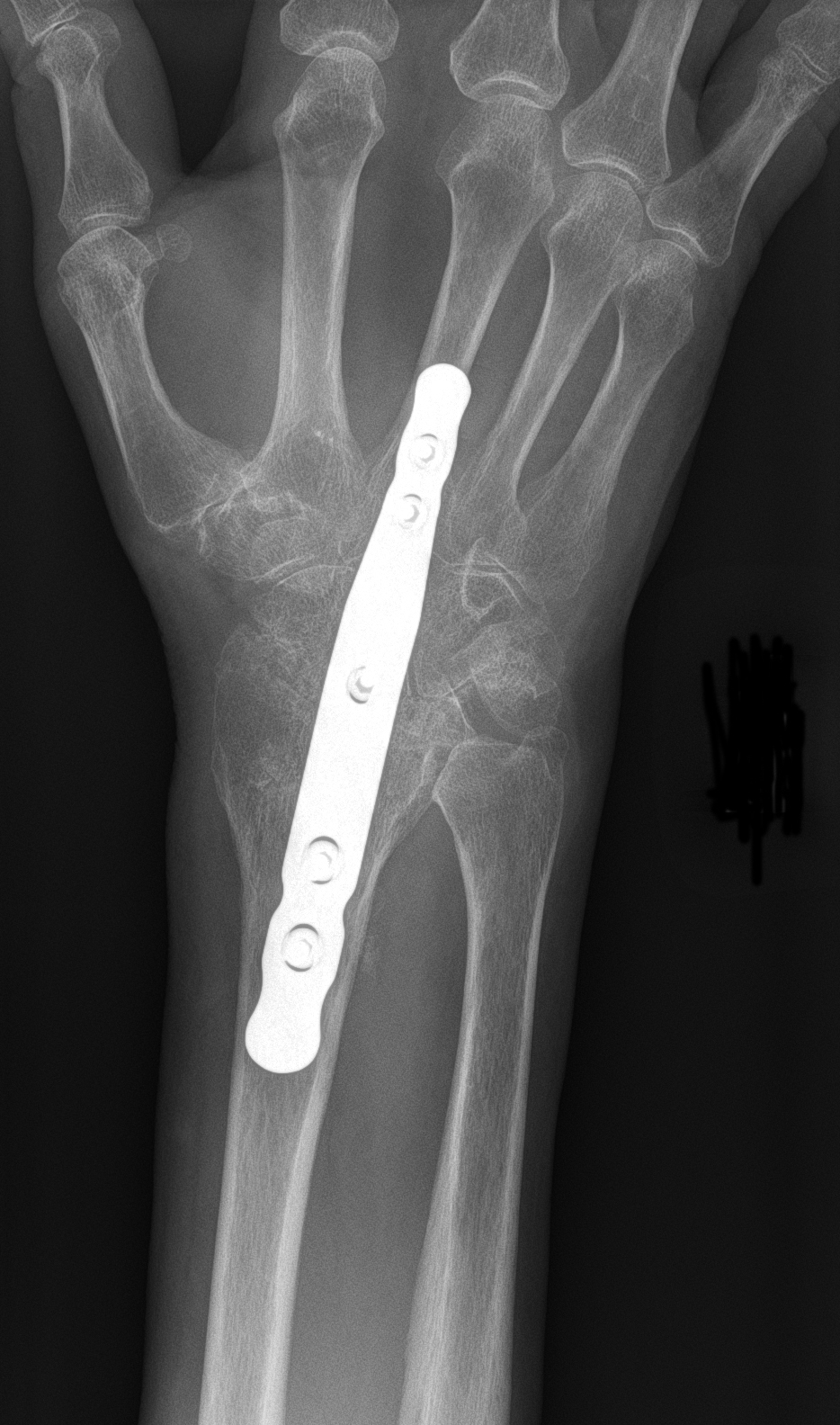 Wrist fusion