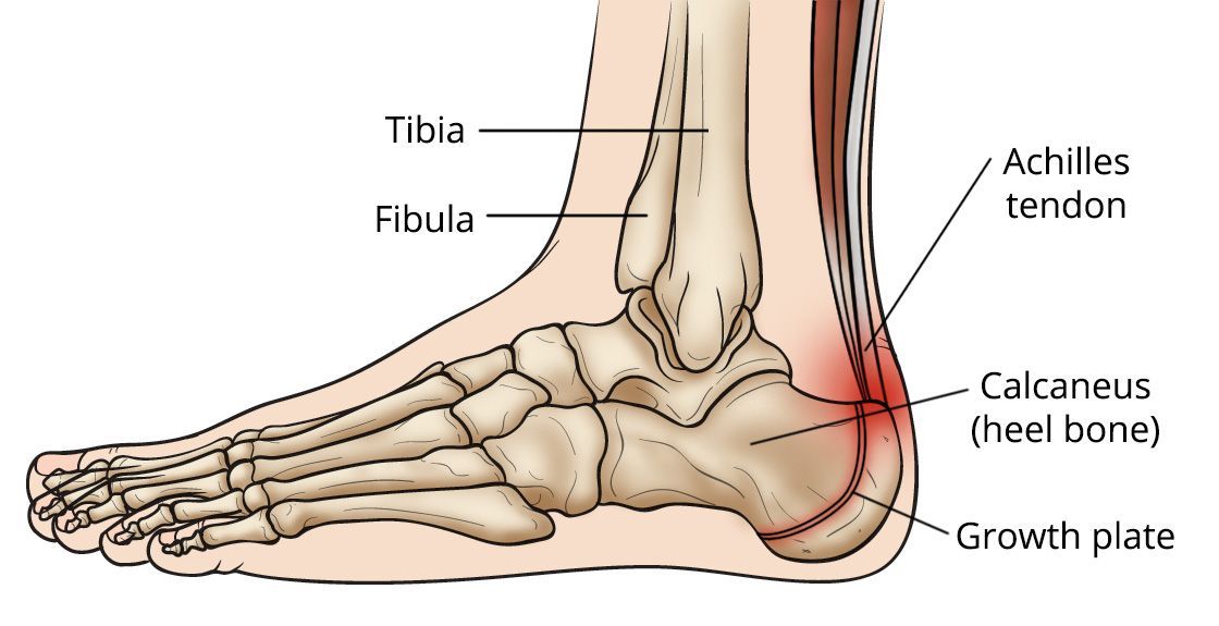 Areas of pain from Sever's disease