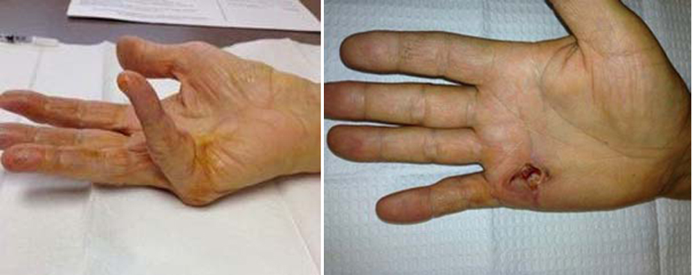 Fasciotomy